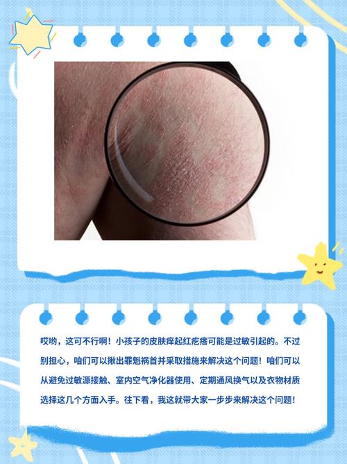 6岁儿童皮肤过敏怎么办?如何快速缓解?-第3张图片-郑州医学网 6岁儿童皮肤过敏怎么办?如何快速缓解?-第3张图片-郑州医学网