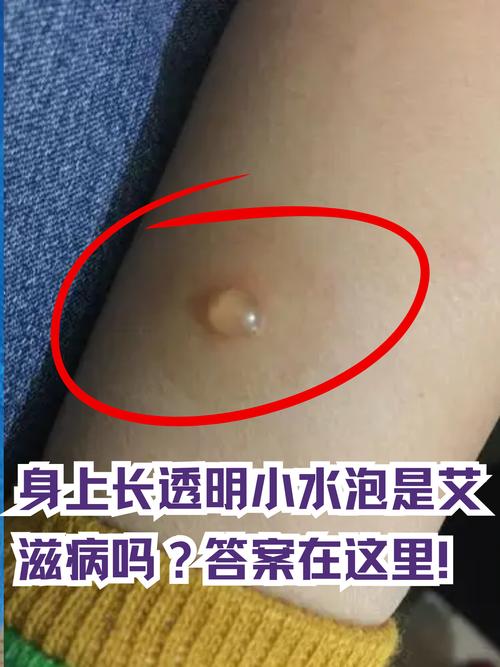 儿童身上长水泡怎么回事-第1张图片-郑州医学网 儿童身上长水泡怎么回事-第1张图片-郑州医学网