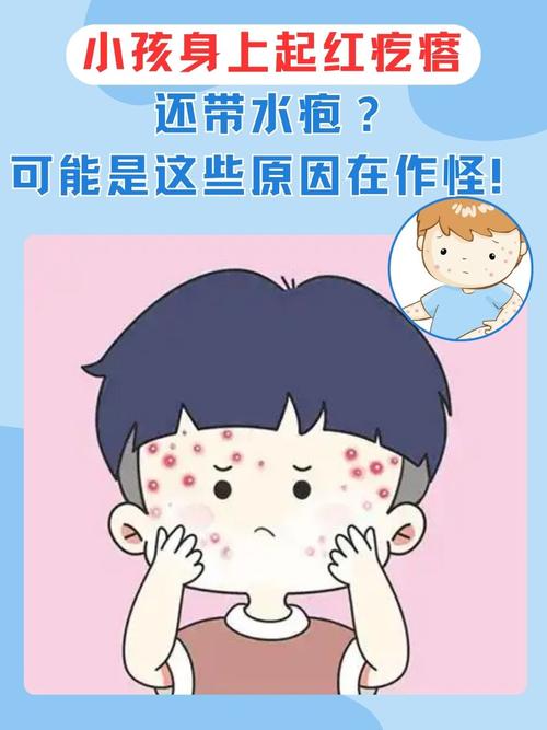 儿童身上长水泡怎么回事-第3张图片-郑州医学网 儿童身上长水泡怎么回事-第3张图片-郑州医学网