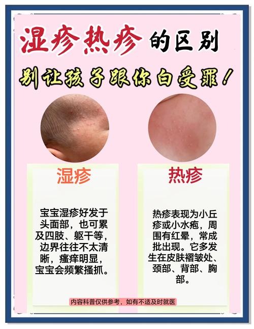 6岁儿童湿疹怎么引起的-第3张图片-郑州医学网 6岁儿童湿疹怎么引起的-第3张图片-郑州医学网