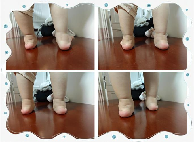 儿童走路姿势异常该挂骨科还是儿童保健科?-第3张图片-郑州医学网 儿童走路姿势异常该挂骨科还是儿童保健科?-第3张图片-郑州医学网