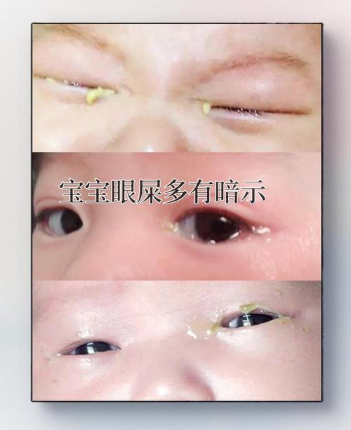 新生儿眼睛黄水流出是正常现象还是异常信号？需警惕哪些眼部疾病风险？-第1张图片-郑州医学网