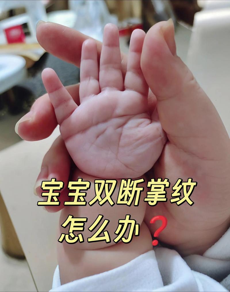 新生儿断掌是先天异常还是发育问题？需要干预吗？-第1张图片-郑州医学网