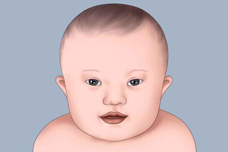 新生儿唐氏综合症症状有哪些?家长该如何早期识别与应对?-第1张图片-郑州医学网 新生儿唐氏综合症症状有哪些?家长该如何早期识别与应对?-第1张图片-郑州医学网