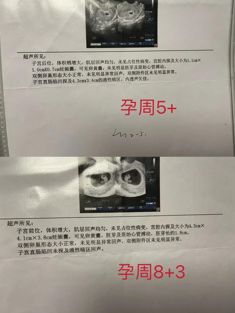 孕囊大小能精准推算受孕时间吗？还是存在误差？-第3张图片-郑州医学网