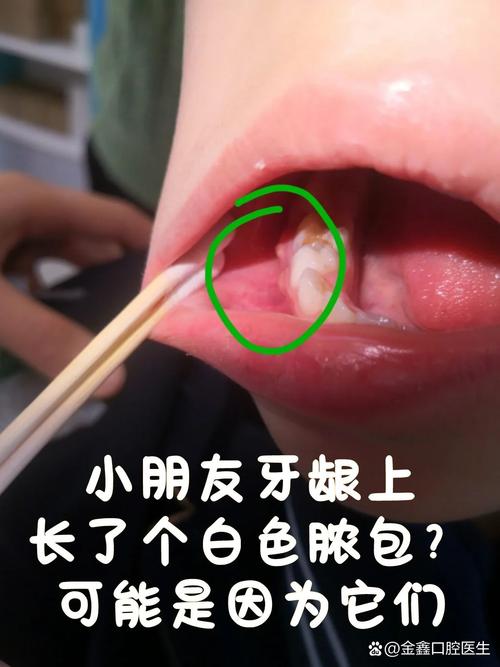 儿童牙龈长脓包该吃什么药?盲目用药会加重感染吗?-第1张图片-郑州医学网 儿童牙龈长脓包该吃什么药?盲目用药会加重感染吗?-第1张图片-郑州医学网