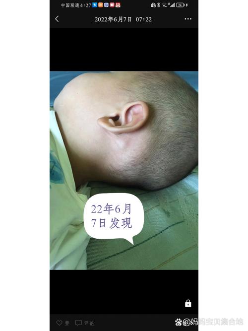 儿童耳后淋巴结肿大图片显示异常,是否需要立即就医排查病因?-第3张图片-郑州医学网 儿童耳后淋巴结肿大图片显示异常,是否需要立即就医排查病因?-第3张图片-郑州医学网