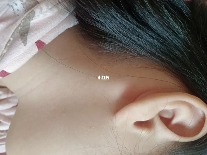儿童耳后淋巴结肿大图片显示异常,是否需要立即就医排查病因?-第1张图片-郑州医学网 儿童耳后淋巴结肿大图片显示异常,是否需要立即就医排查病因?-第1张图片-郑州医学网