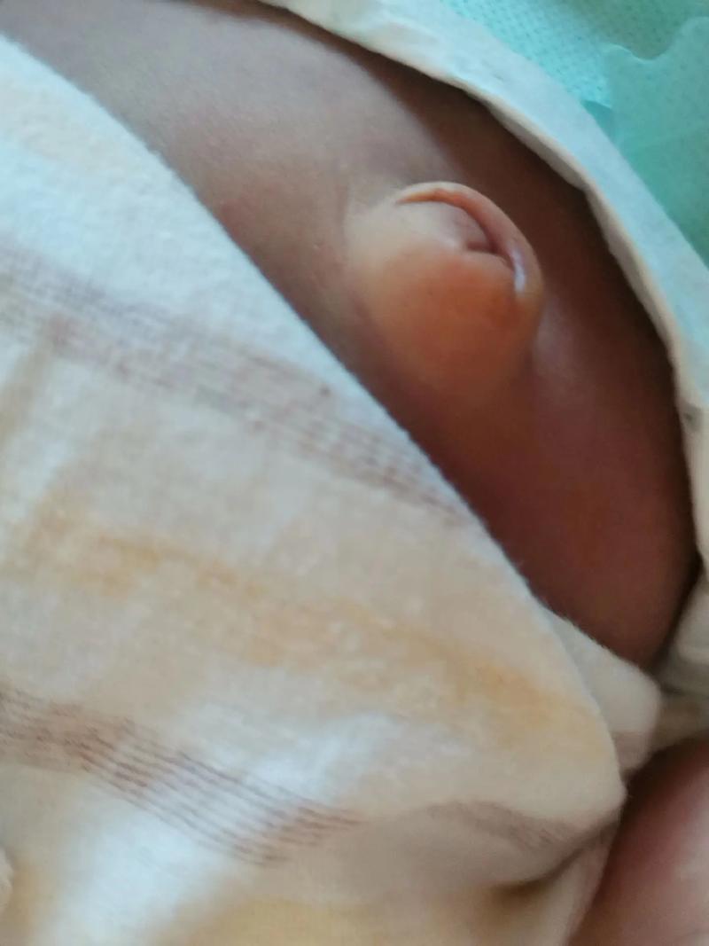 新生儿肚脐突出是正常现象还是异常信号？需警惕哪些潜在风险？-第3张图片-郑州医学网