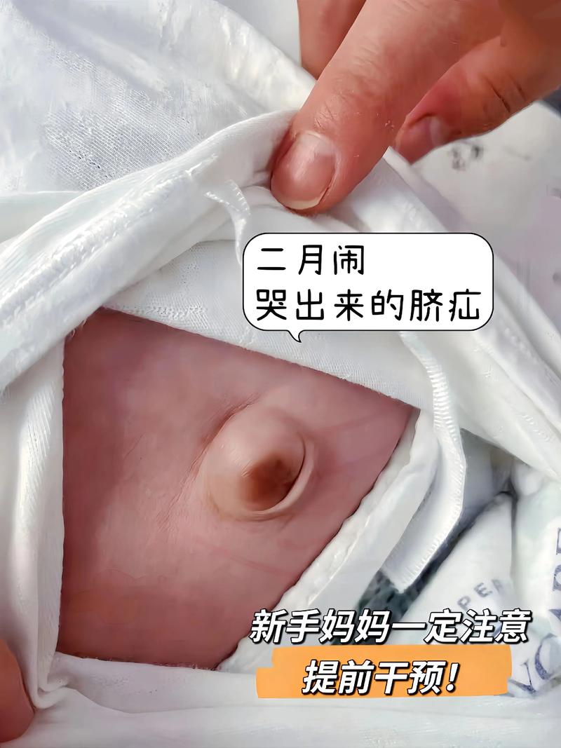 新生儿肚脐突出是正常现象还是异常信号？需警惕哪些潜在风险？-第1张图片-郑州医学网
