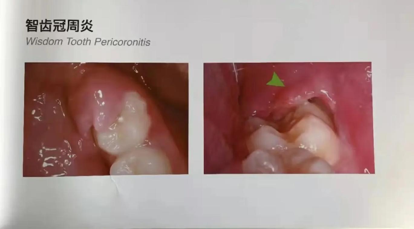 孕期智齿旁肉肿了怎么办?对胎儿有影响吗?需要拔牙吗?-第2张图片-郑州医学网 孕期智齿旁肉肿了怎么办?对胎儿有影响吗?需要拔牙吗?-第2张图片-郑州医学网
