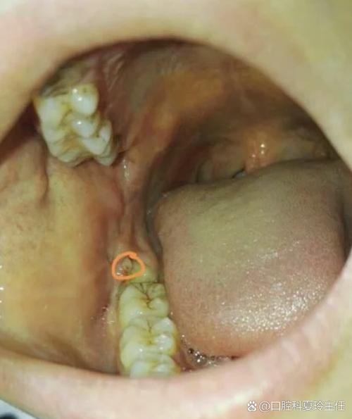 孕期智齿旁肉肿了怎么办？对胎儿有影响吗？需要拔牙吗？-第3张图片-郑州医学网