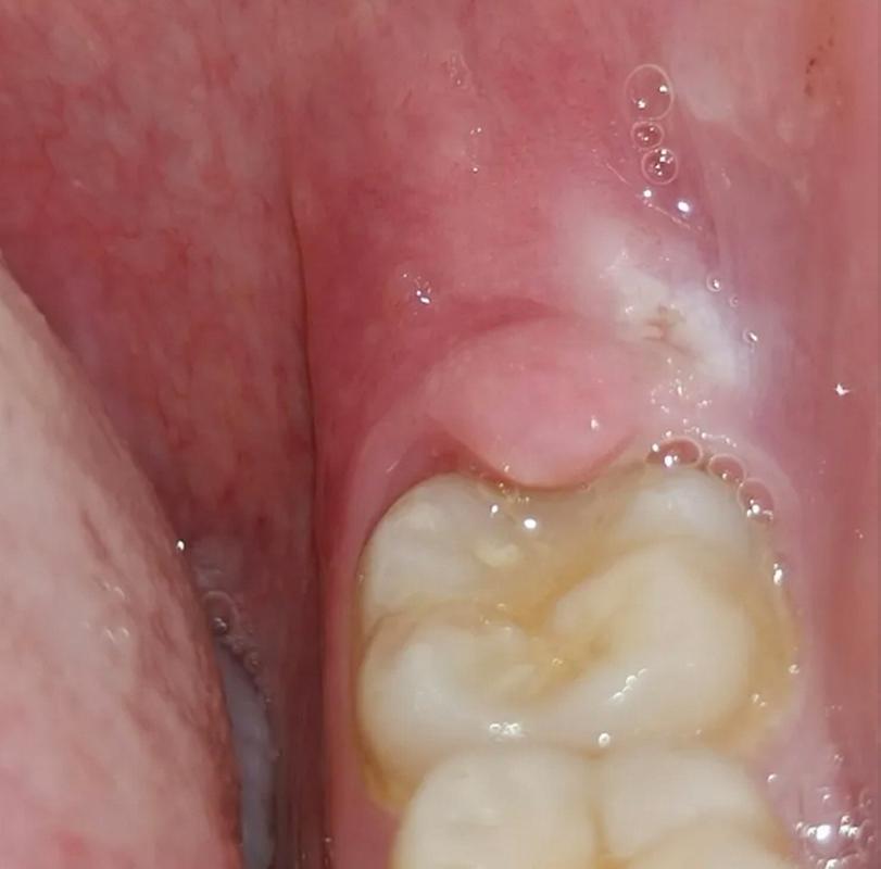 孕期智齿旁肉肿了怎么办?对胎儿有影响吗?需要拔牙吗?-第1张图片-郑州医学网 孕期智齿旁肉肿了怎么办?对胎儿有影响吗?需要拔牙吗?-第1张图片-郑州医学网