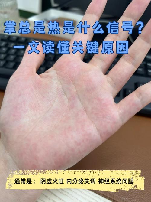 孕期手心莫名发烫是正常现象还是疾病信号？需要担心吗？-第1张图片-郑州医学网