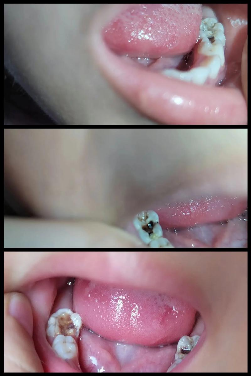 儿童乳牙也能做根管治疗吗?会不会影响以后换牙?-第1张图片-郑州医学网 儿童乳牙也能做根管治疗吗?会不会影响以后换牙?-第1张图片-郑州医学网