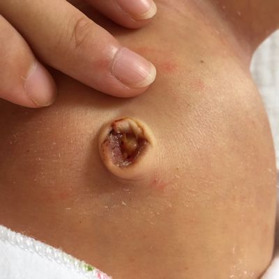 新生儿脐带脱落后出现褐色分泌物正常吗?需要处理吗?-第3张图片-郑州医学网 新生儿脐带脱落后出现褐色分泌物正常吗?需要处理吗?-第3张图片-郑州医学网