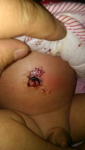 15天新生儿肚脐出血是正常现象还是需要紧急处理的异常情况？-第2张图片-郑州医学网