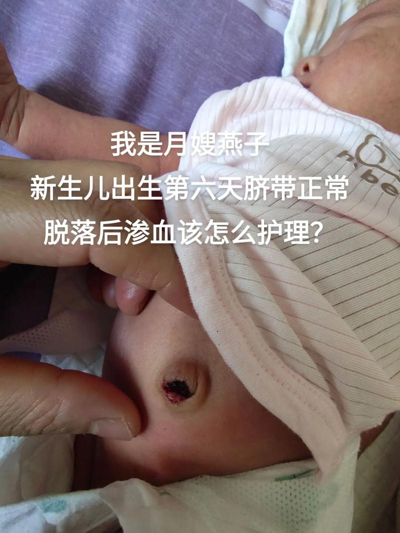 15天新生儿肚脐出血是正常现象还是需要紧急处理的异常情况？-第3张图片-郑州医学网