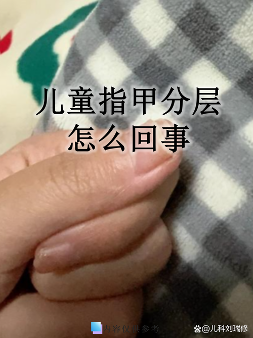 儿童指甲无故脱落是缺乏营养还是疾病信号？需警惕哪些潜在问题？-第1张图片-郑州医学网