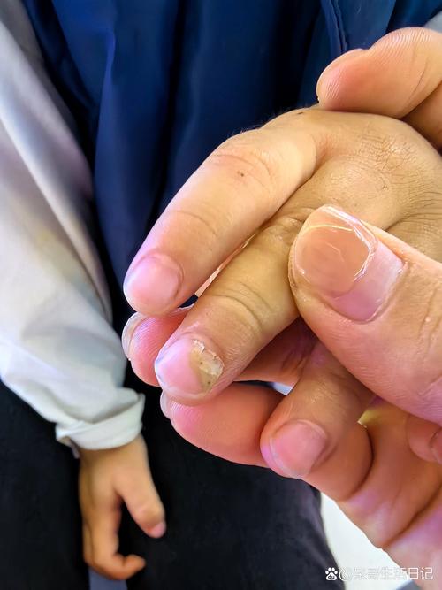 儿童指甲无故脱落是缺乏营养还是疾病信号？需警惕哪些潜在问题？-第3张图片-郑州医学网