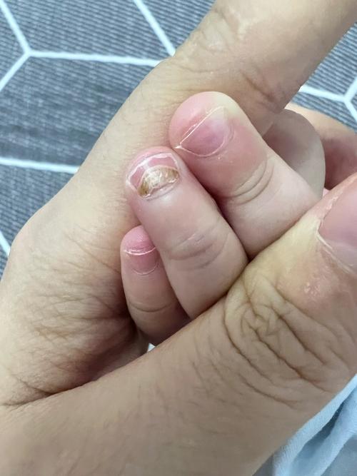 儿童指甲无故脱落是缺乏营养还是疾病信号？需警惕哪些潜在问题？-第2张图片-郑州医学网