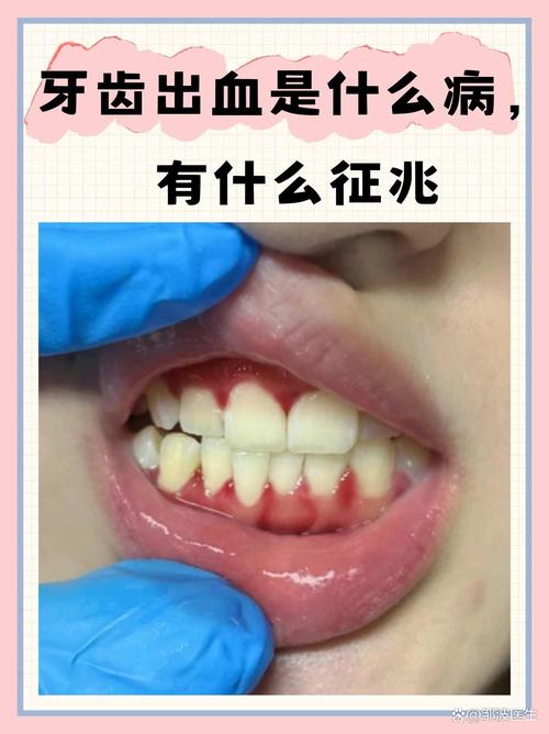 孕期一睡觉就牙龈出血，是正常现象还是身体在发出预警信号？-第1张图片-郑州医学网