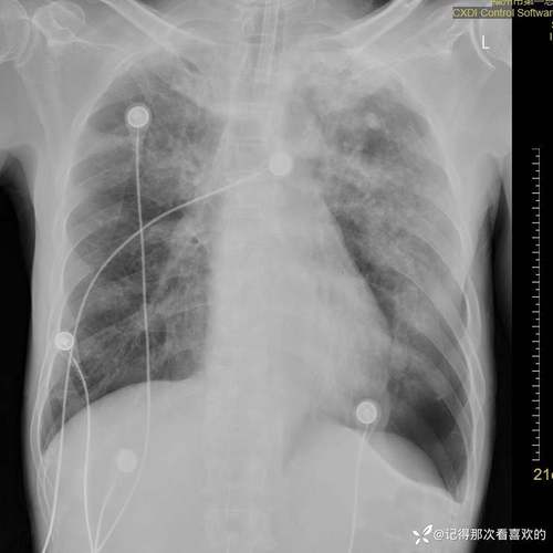 儿童游泳后出现吸入性肺炎，会有哪些典型症状需要家长警惕？-第3张图片-郑州医学网