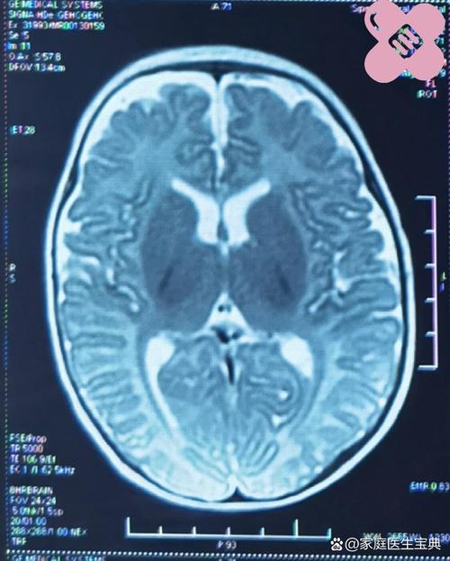 新生儿核磁共振究竟会检查身体哪些部位,能发现哪些潜在问题呢?-第1张图片-郑州医学网 新生儿核磁共振究竟会检查身体哪些部位,能发现哪些潜在问题呢?-第1张图片-郑州医学网