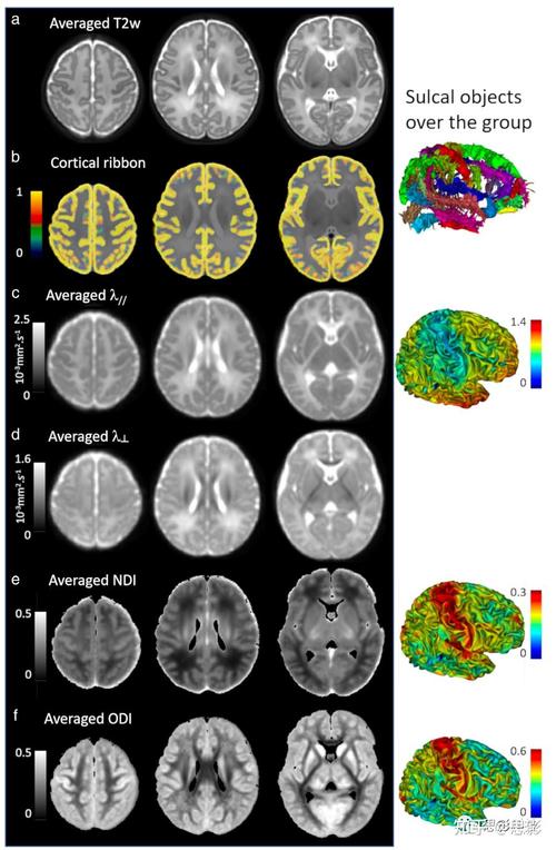新生儿核磁共振究竟会检查身体哪些部位,能发现哪些潜在问题呢?-第2张图片-郑州医学网 新生儿核磁共振究竟会检查身体哪些部位,能发现哪些潜在问题呢?-第2张图片-郑州医学网