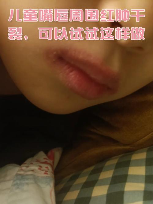 儿童嘴唇干裂是缺水、过敏还是疾病信号？家长该如何科学应对？-第3张图片-郑州医学网