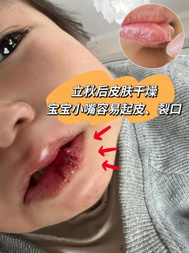 儿童嘴唇干裂是缺水、过敏还是疾病信号？家长该如何科学应对？-第2张图片-郑州医学网