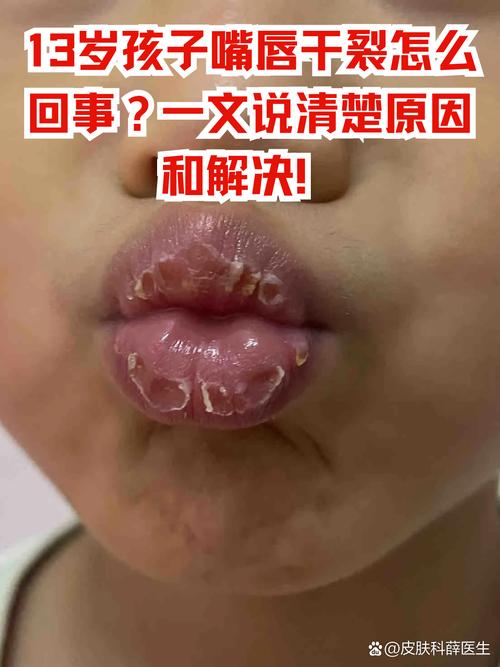 儿童嘴唇干裂是缺水、过敏还是疾病信号？家长该如何科学应对？-第1张图片-郑州医学网