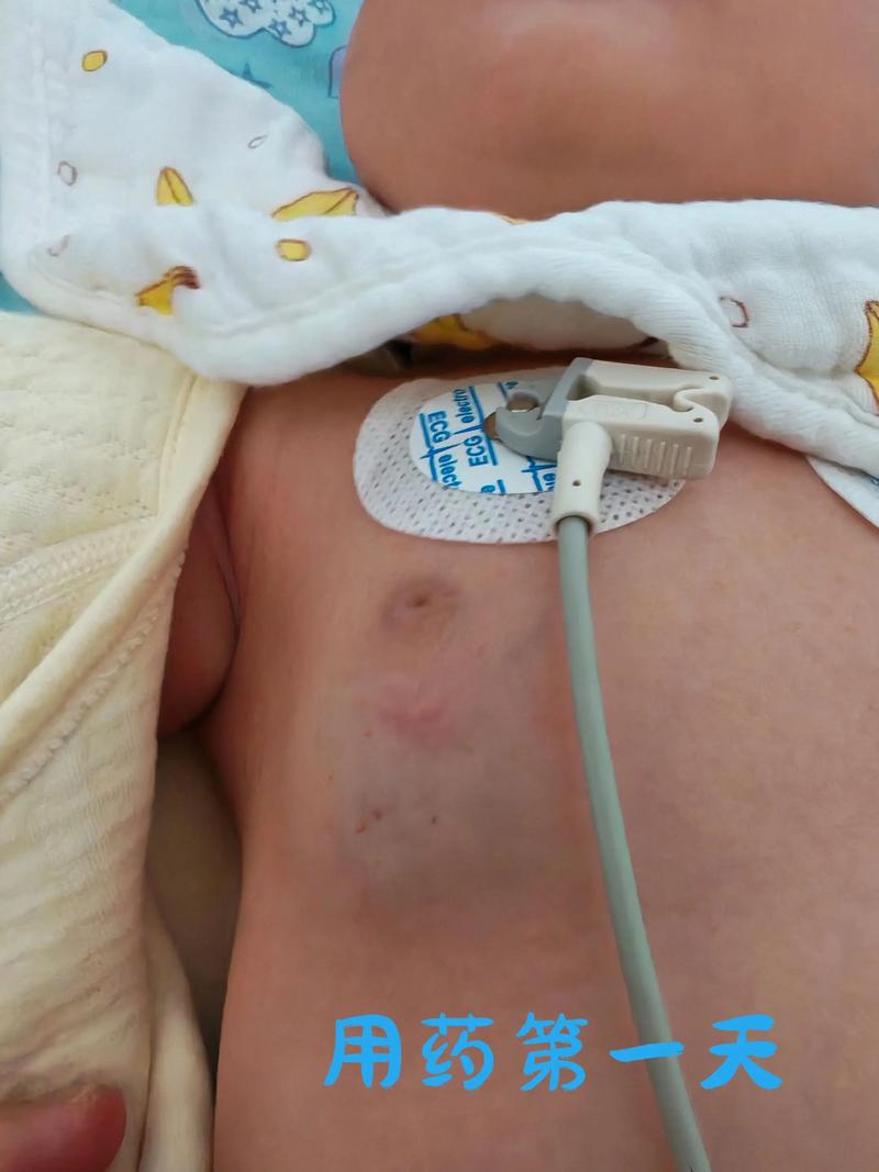 新生儿长血管瘤是先天发育问题还是后天因素导致的？-第3张图片-郑州医学网