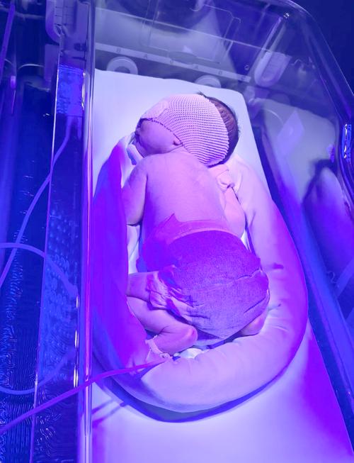 新生儿溶血性黄疸照蓝光，原理是什么？家长需要知道哪些注意事项？-第3张图片-郑州医学网