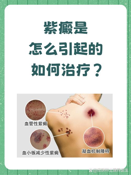 儿童过敏性紫癜治疗关键是什么？激素用药、饮食管理及复发预防全解析-第2张图片-郑州医学网