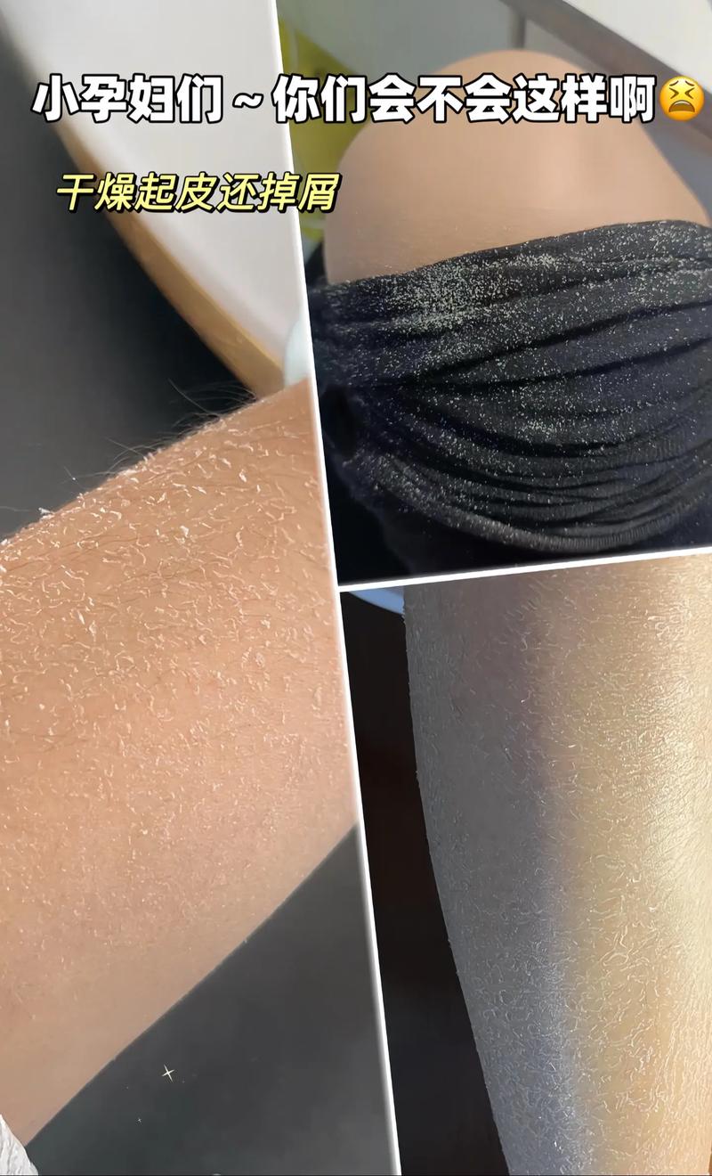 孕期皮肤干燥起皮又痒,如何安全保湿不伤胎儿?-第2张图片-郑州医学网 孕期皮肤干燥起皮又痒,如何安全保湿不伤胎儿?-第2张图片-郑州医学网