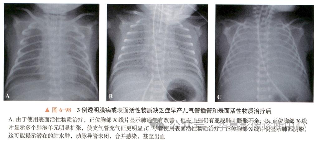 新生儿肺透明膜病3天后病情会好转吗?需注意哪些并发症风险?-第1张图片-郑州医学网 新生儿肺透明膜病3天后病情会好转吗?需注意哪些并发症风险?-第1张图片-郑州医学网