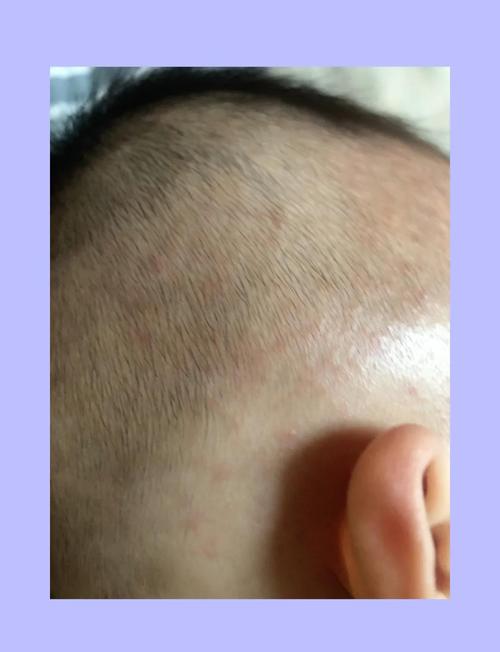 新生儿头上起痱子怎么办？如何正确护理才能快速缓解并避免复发？-第1张图片-郑州医学网
