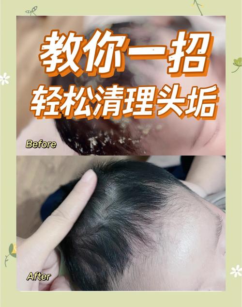 新生儿头上起痱子怎么办？如何正确护理才能快速缓解并避免复发？-第3张图片-郑州医学网