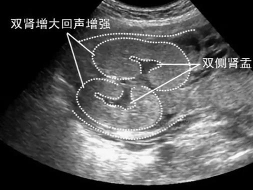 新生儿双肾集合系统分离需要立即治疗吗？分离宽度和宝宝健康有什么关系？-第3张图片-郑州医学网