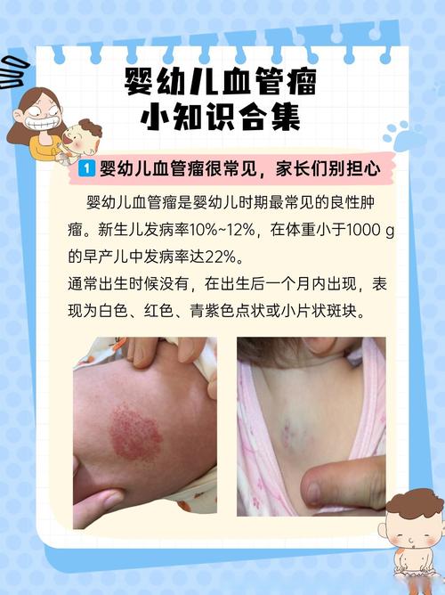 儿童过敏性紫癜该挂什么科？挂号前需了解这些关键信息！-第1张图片-郑州医学网
