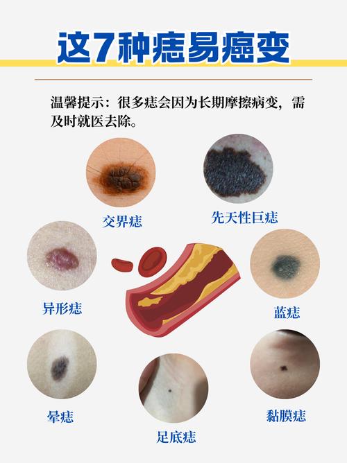 怀孕期间黑痣变化是正常现象吗？需要警惕哪些异常情况？-第2张图片-郑州医学网