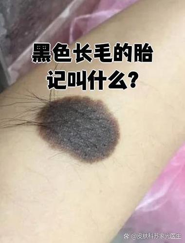 怀孕期间黑痣变化是正常现象吗？需要警惕哪些异常情况？-第3张图片-郑州医学网