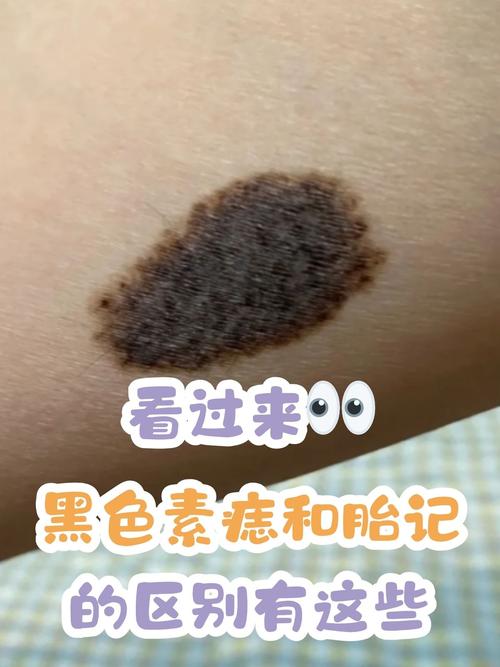 怀孕期间黑痣变化是正常现象吗？需要警惕哪些异常情况？-第1张图片-郑州医学网
