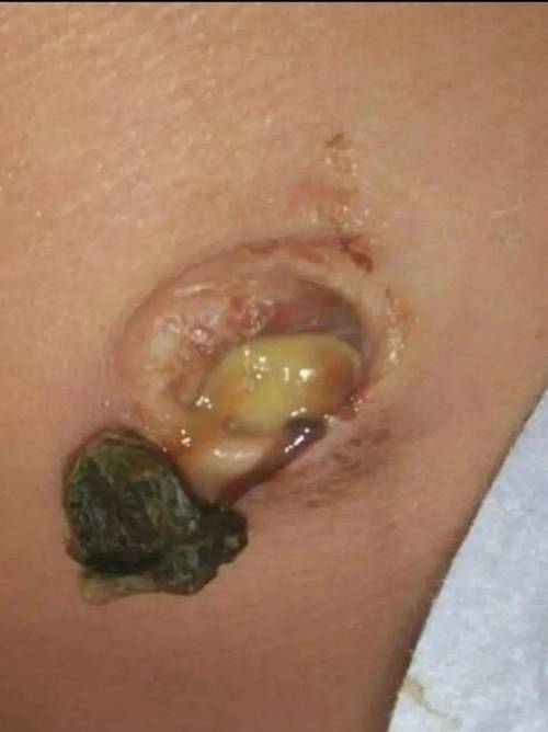 新生儿13天肚脐眼出血是正常现象吗？需要立即就医处理吗？-第2张图片-郑州医学网