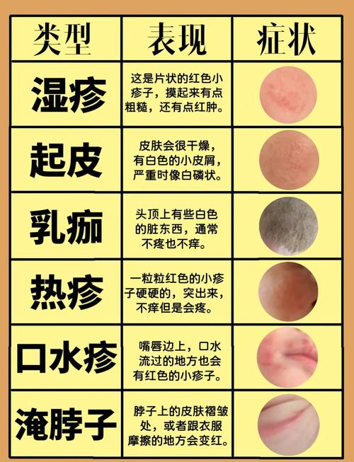 新生儿干燥型湿疹反复发作，到底该怎么护理才能好得快？-第1张图片-郑州医学网