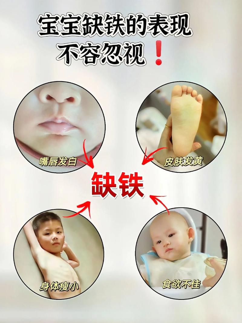新生儿缺铁有哪些容易被忽视的表现和症状？-第2张图片-郑州医学网