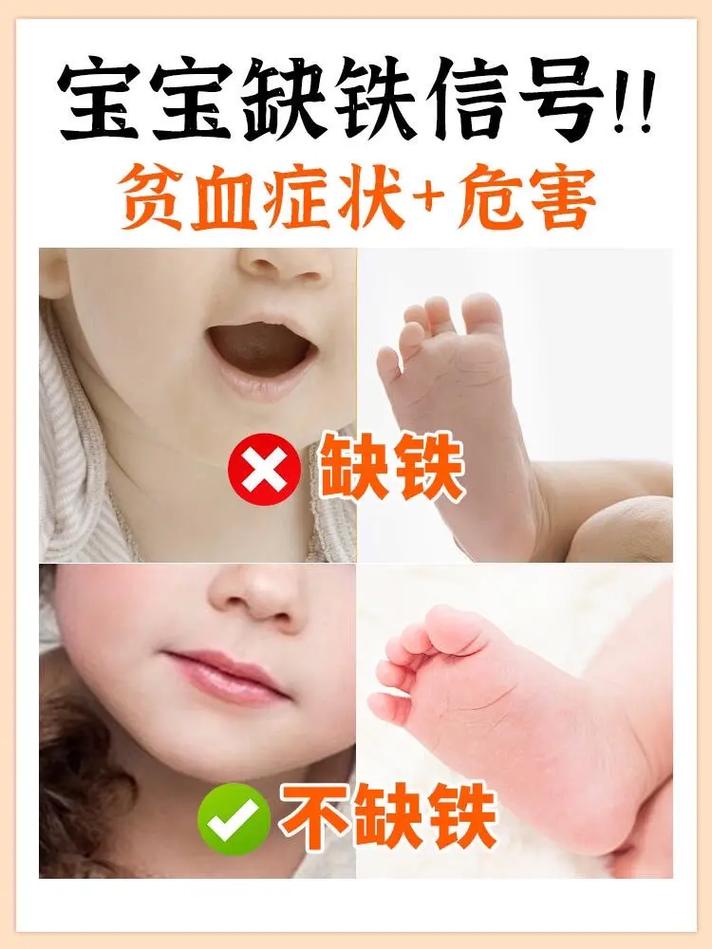 新生儿缺铁有哪些容易被忽视的表现和症状？-第3张图片-郑州医学网