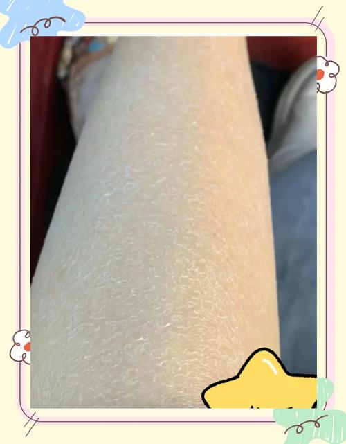 怀孕期间皮肤干燥脱皮,是激素变化还是缺水?该如何有效缓解?-第2张图片-郑州医学网 怀孕期间皮肤干燥脱皮,是激素变化还是缺水?该如何有效缓解?-第2张图片-郑州医学网