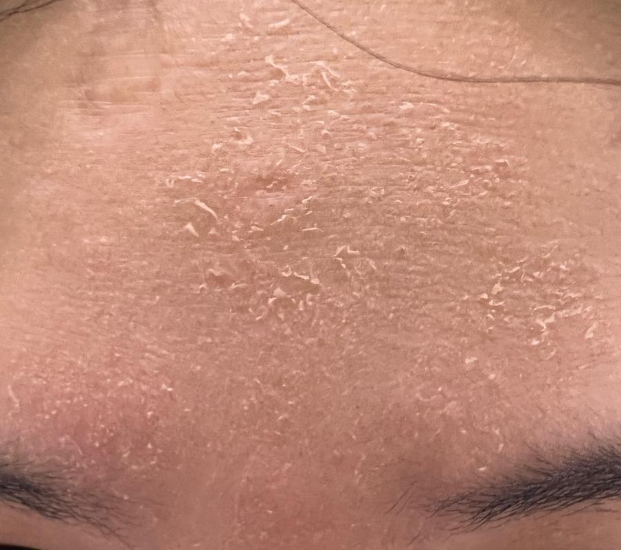 怀孕期间皮肤干燥脱皮,是激素变化还是缺水?该如何有效缓解?-第1张图片-郑州医学网 怀孕期间皮肤干燥脱皮,是激素变化还是缺水?该如何有效缓解?-第1张图片-郑州医学网